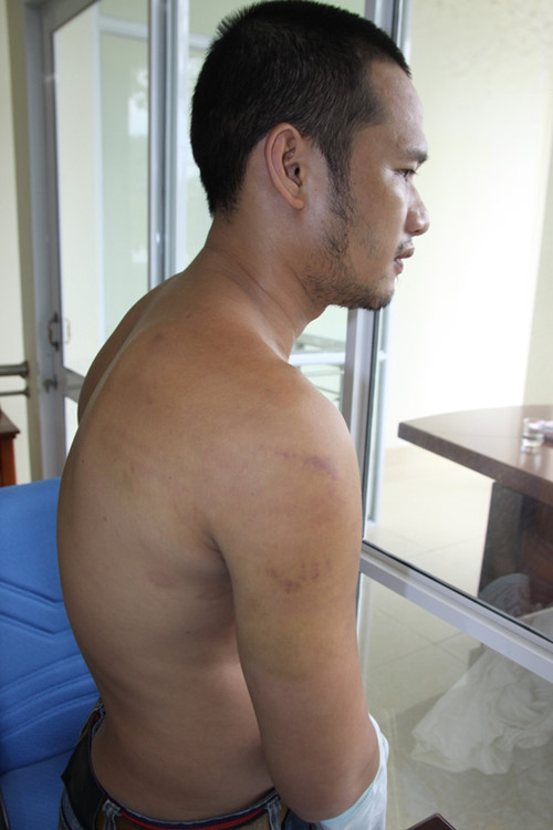 Bùi Minh Trang và những vết bầm tím trên thân thể cho công an đánh đập. Ảnh: Thanh Niên 