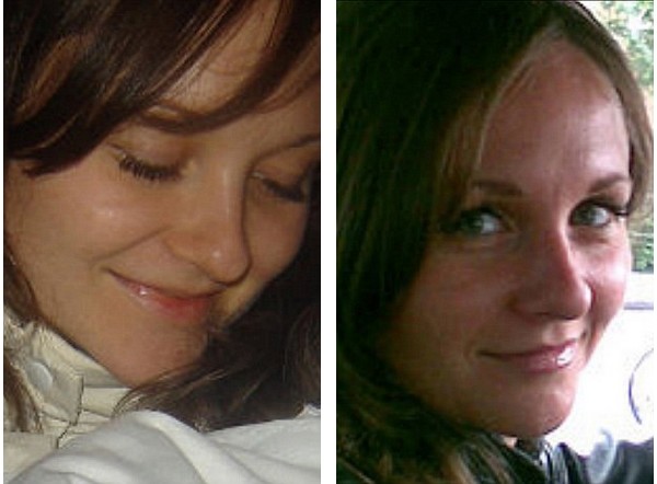 Anna trước (trái) và sau (phải) khi thực hiện phẫu thuật thẩm mỹ mũi