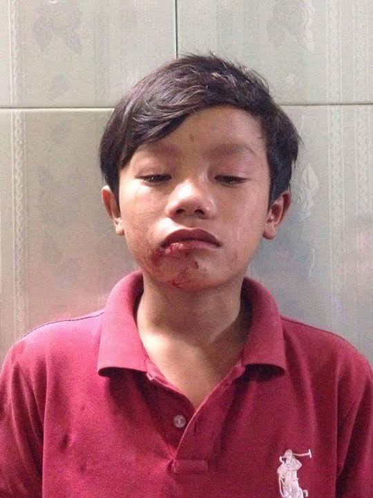 Em Nguyễn Ngọc Thắng với vết thương nơi miệng sau khi bị thầy Dự đánh (ảnh; Facebook Lee Jong Suk)