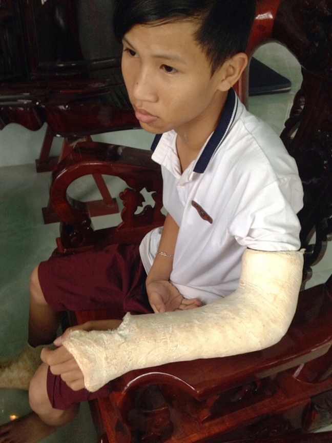  Sau khi bị tai nạn, Hiếu bị gãy tay trái, xương bàn chân và răng. Ảnh: Phụ Nữ Online
