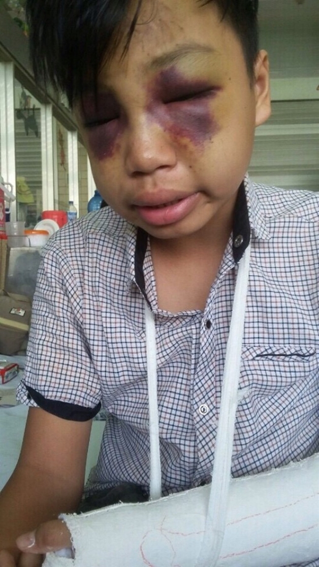 Nguyễn Hào Quang gãy tay trái, mắt tụ máu sau vụ tai nạn, còn Phùng Viết Quân tử vong tại chỗ. Ảnh: Phụ Nữ Online