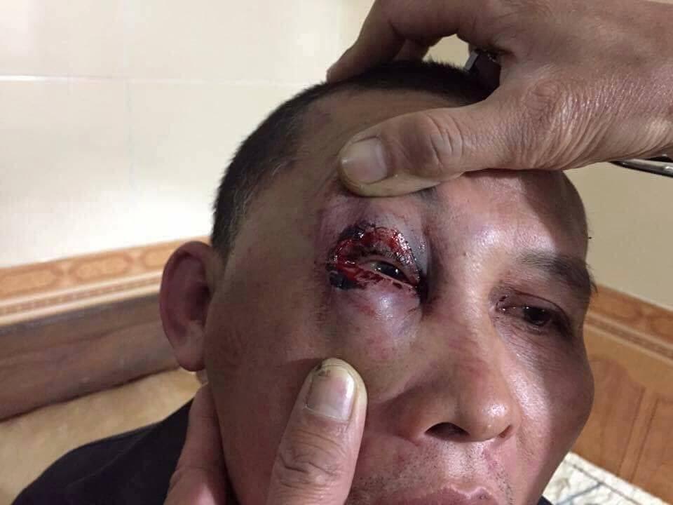 Vết thương trên mí mắt anh Nguyễn Thành Huân (ảnh; Facebook Thanh Niên Công Gíao)